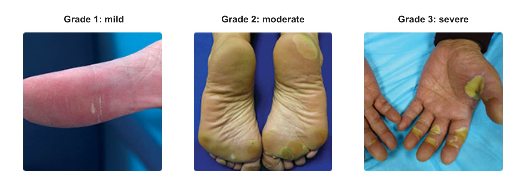 Examples of mild (grade 1), moderate (grade 2), and severe (grade 3) levels of HSFR in STIVARGA (regorafenib) patients.
